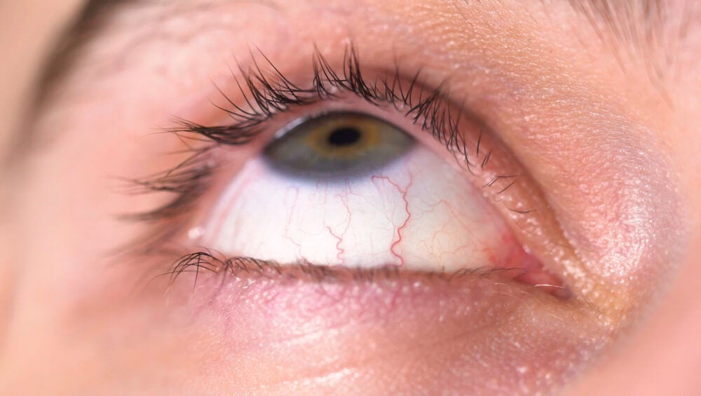 Gözde Demodex Akarları Nasıl Anlaşılır?